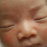 【新生児も】赤ちゃんの顔に赤いぶつぶつができた・・これって何？