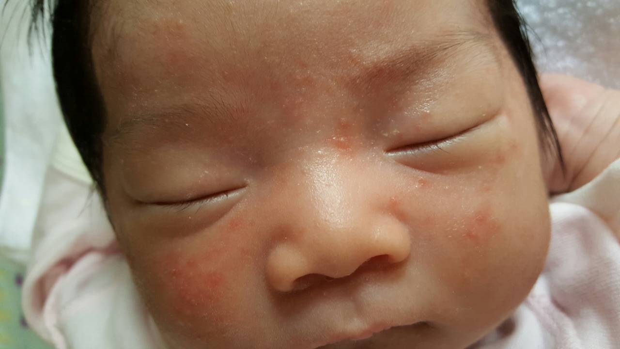 新生児も 赤ちゃんの顔に赤いぶつぶつができた これって何 ベビーライフ